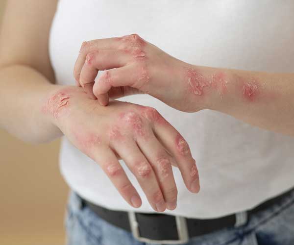 Psoriaza a Čaga